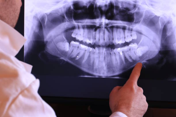Best Emergency Wisdom Tooth Extraction in Quakertown, PA